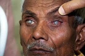 Corneal Blindness Backlog Free State